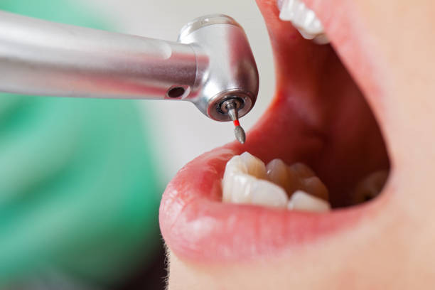 Best Dental Abscess Treatment in Boonsboro, MD
